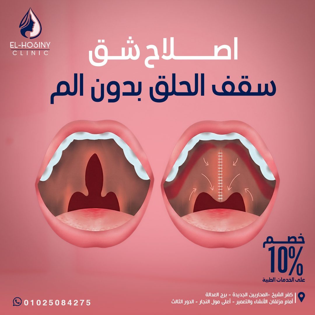 Cleft Palate Repair